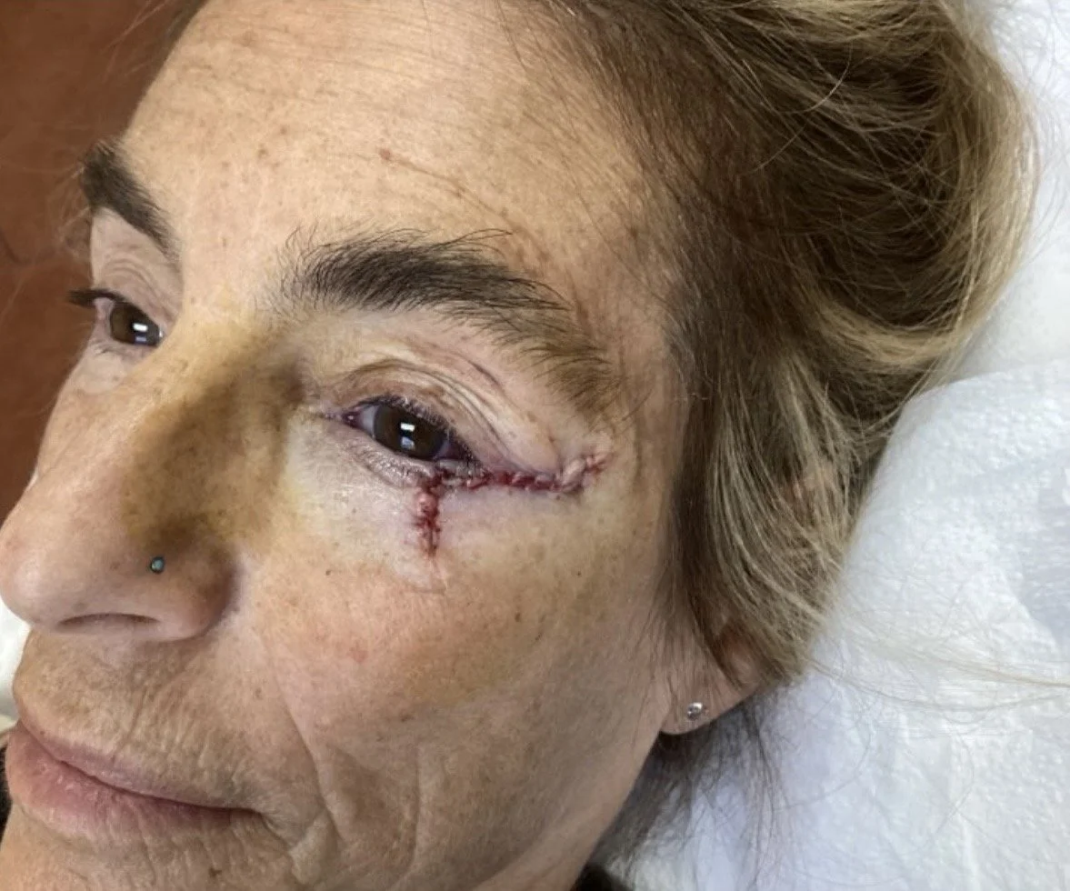 Close-up of a woman's face showing a stitched wound near her eye, with freckled skin, a nose piercing, and light brown hair.