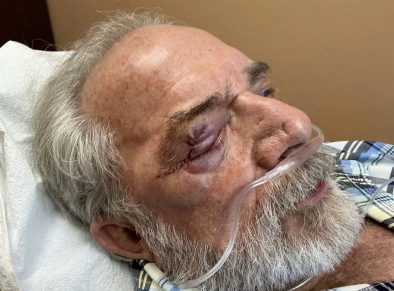 Close-up of an elderly man lying in a hospital bed with a nasal oxygen tube, visible bruising and swelling around his eye, and a hospital gown.