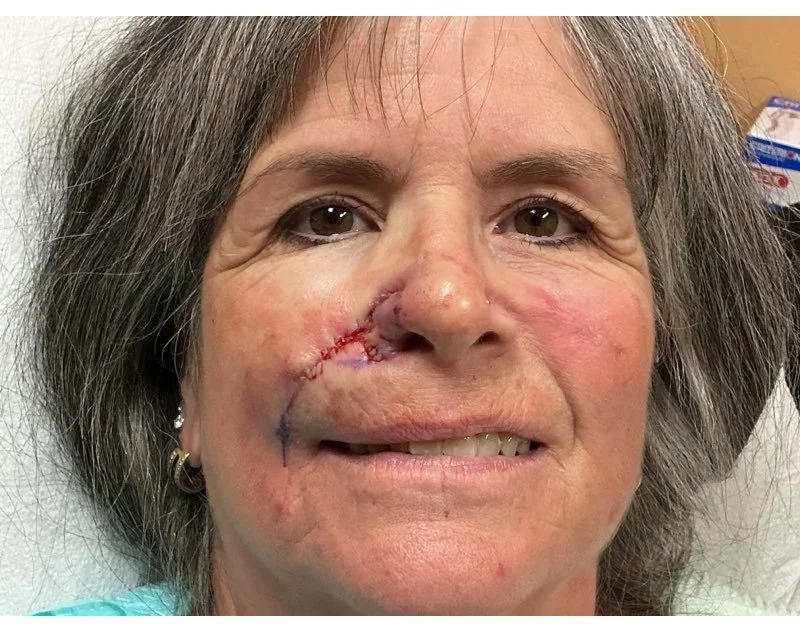 Close-up of a middle-aged woman with a surgical scar on her face, smiling slightly in a medical setting.