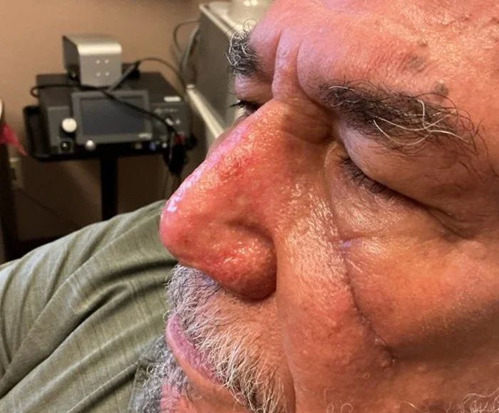 Close-up of an elderly man's face showing a severe skin condition, with a focus on his nose and closed eye.