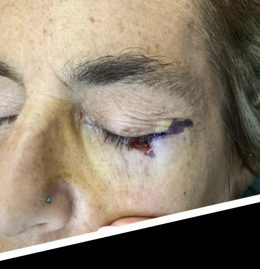 Close-up of a person's face showing a black eye with bruising, swelling, and dried blood, with the eye closed.