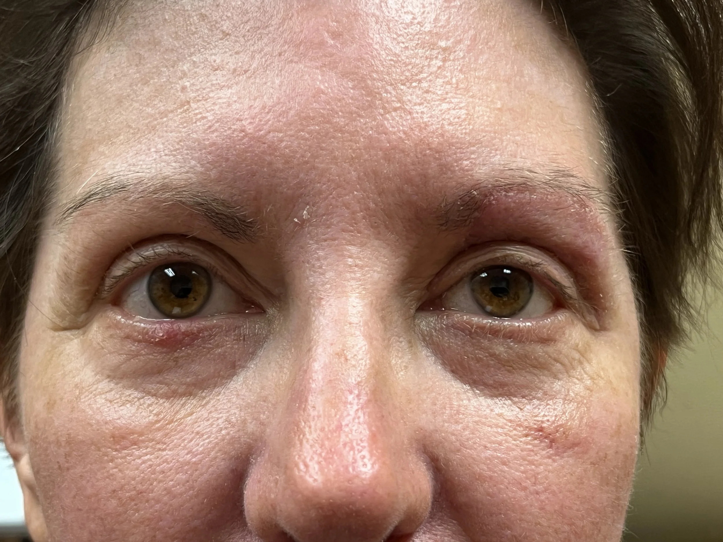 Close-up of a person's forehead with visible skin texture and sparse hair.