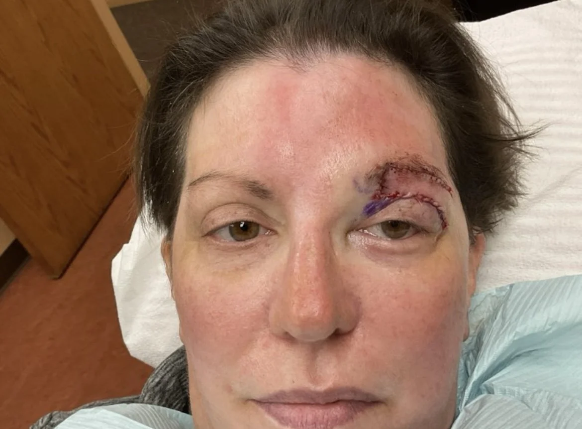 A woman with facial swelling and bruising above her right eye, likely after medical or cosmetic procedure, lying on a hospital bed.
