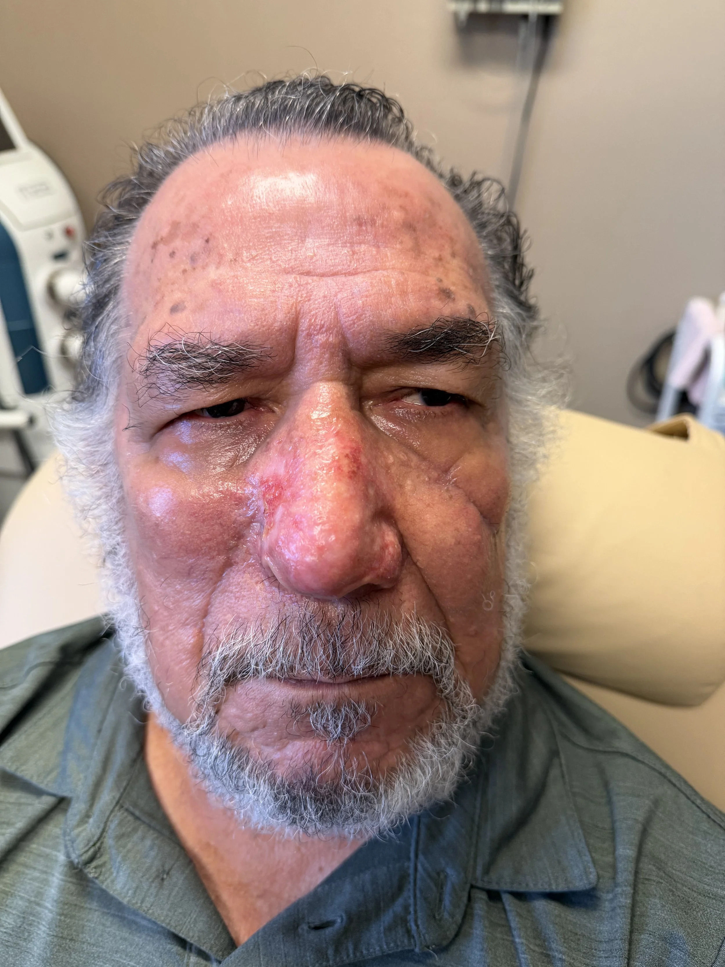 Close-up of an elderly man with gray hair and beard, showing signs of skin redness and inflammation on his face, especially on his forehead and nose, possibly in a medical setting.