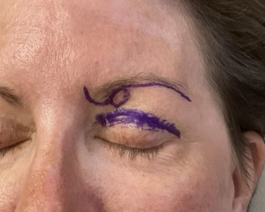 A close-up of a person's face with an eye closed, showing purple marker lines on the eyelid, possibly for makeup or cosmetic purposes.