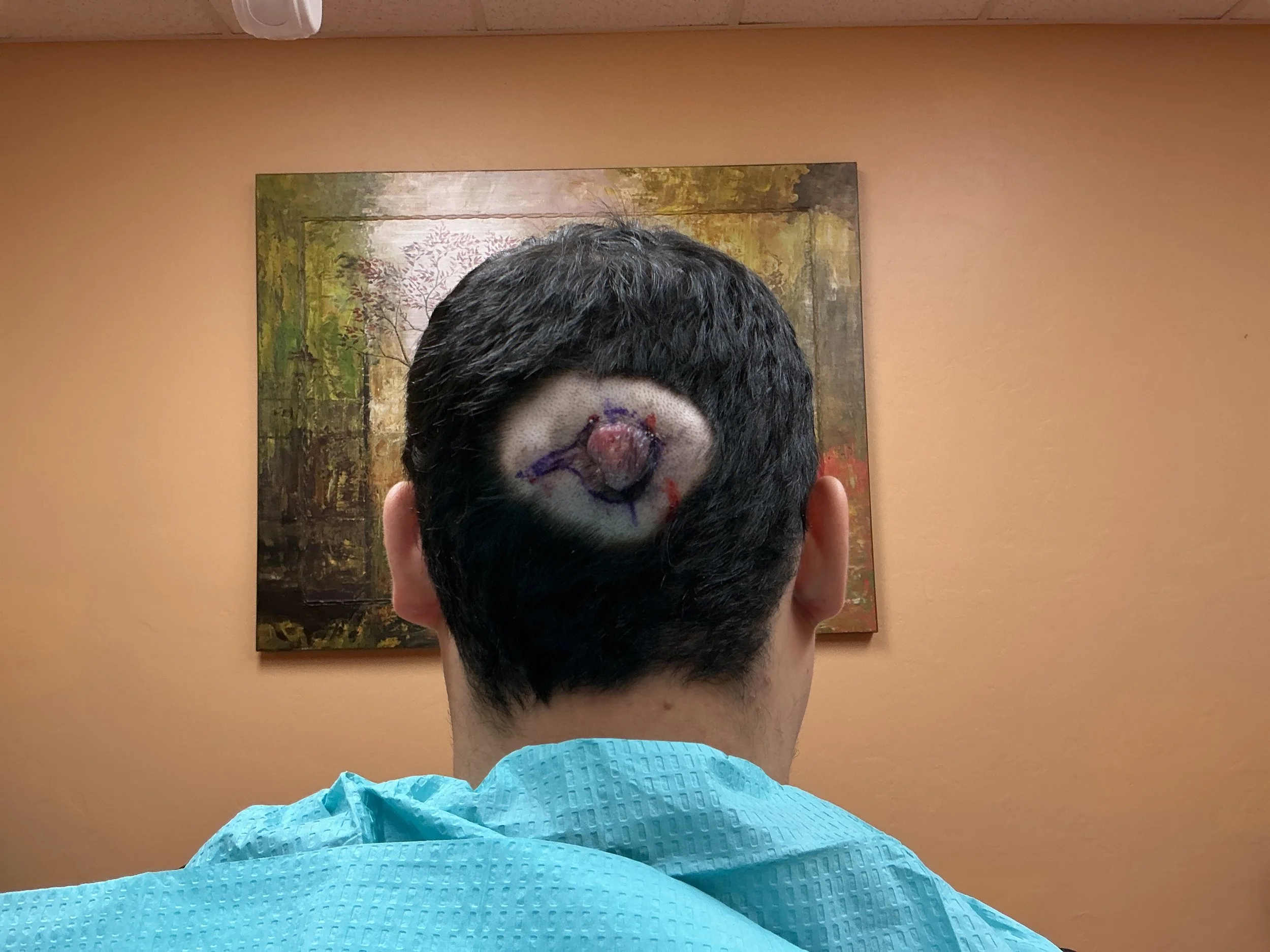 The back of a person's head with dark hair, with a painted or makeup-covered face resembling a clown or spooky figure, seen in a mirror. The person is wearing a medical gown, and the background features a framed painting of a forest scene.