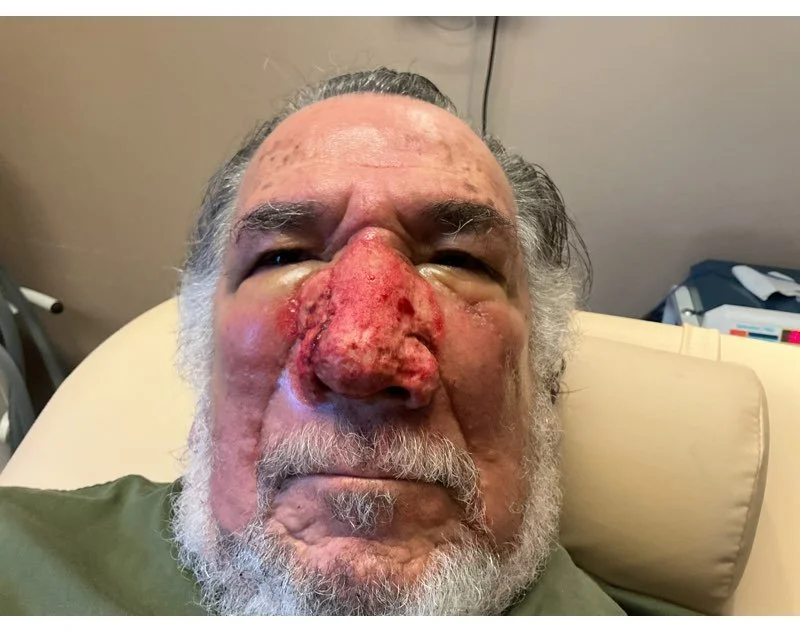 An elderly man lying on a hospital bed with a swollen, red nose, indicating a medical condition or injury.