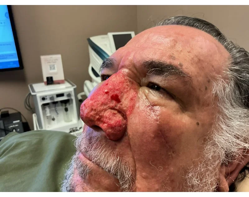 Close-up of an elderly man with a large, red, swollen nose in a medical setting, showing visible redness, swelling, and some skin irritation.