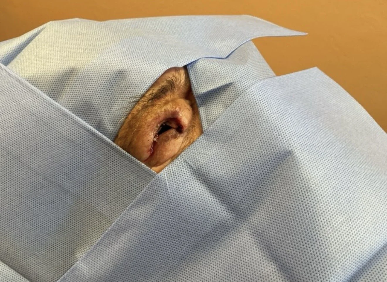 An elderly person's face is partially visible, with their eyes covered by a light blue surgical drape, showing only the nose and mouth areas that appear to be lying on a medical bed.