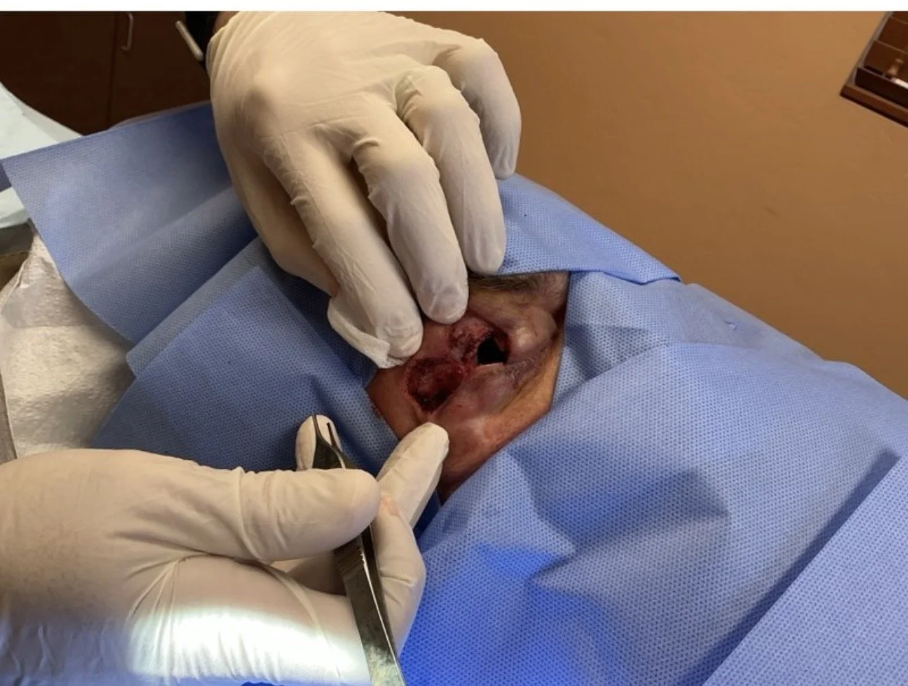Medical professional wearing gloves performs a procedure on a patient’s nose.