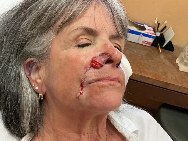 A woman with a healing surgical scar on her nose and face, resting in a medical setting.
