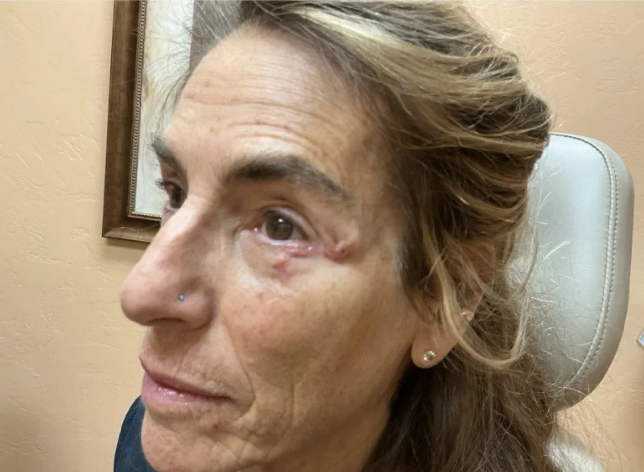 Close-up of a woman with a nose piercing, sitting in a medical office chair, showing signs of facial injuries around her eye and cheek.