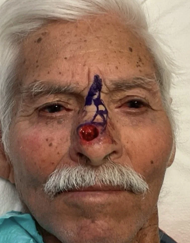 Close-up of an elderly man with a nose wound, showing medical markings and a red ball on his nose, indicating a medical procedure or treatment.