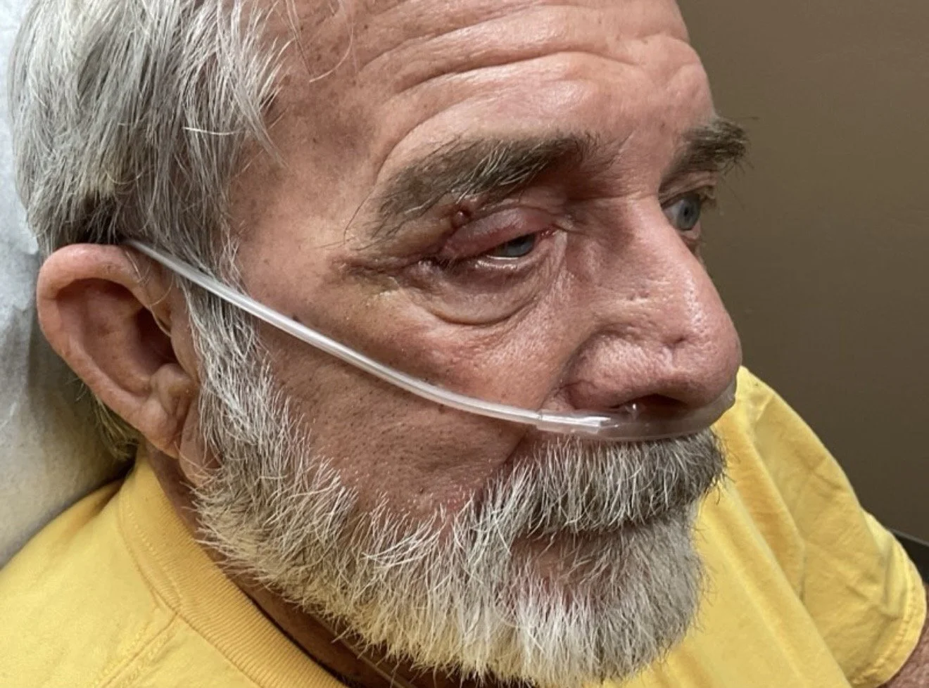 Close-up of an elderly man with gray hair and beard, wearing a nasal oxygen tube, lying in a hospital bed, appearing tired or in pain.