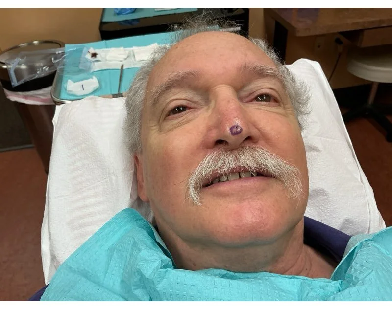 An elderly man with a mustache lying in a hospital bed, undergoing a medical procedure. His nose has a small purple mark, and medical supplies are visible on a tray beside him.