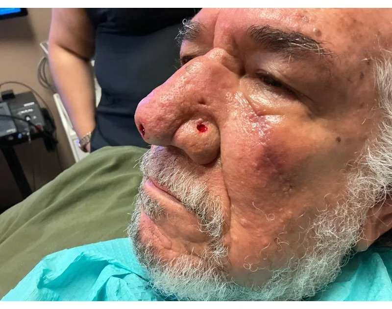 Close-up of an elderly man with a small, circular wound on his nose and another on his cheek, lying on a medical examination table with a medical gown.