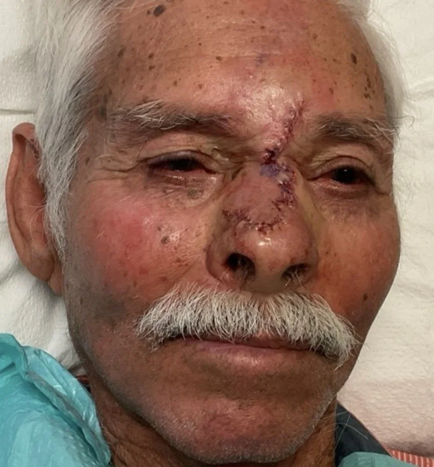Close-up of an elderly man with a stitched wound on his nose, swollen and bruised face, and wearing a medical gown.