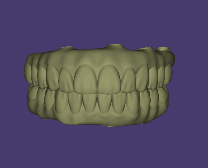 3D Exocad Designs