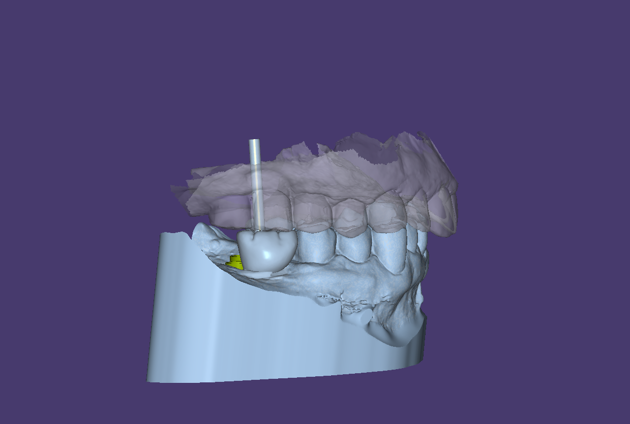 Crowns and Bridges