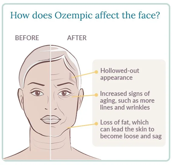 ozempic-face-1.jpg