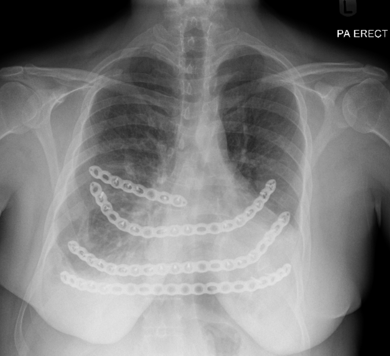 X-ray image of a chest showing a chain of rings inside the stomach.
