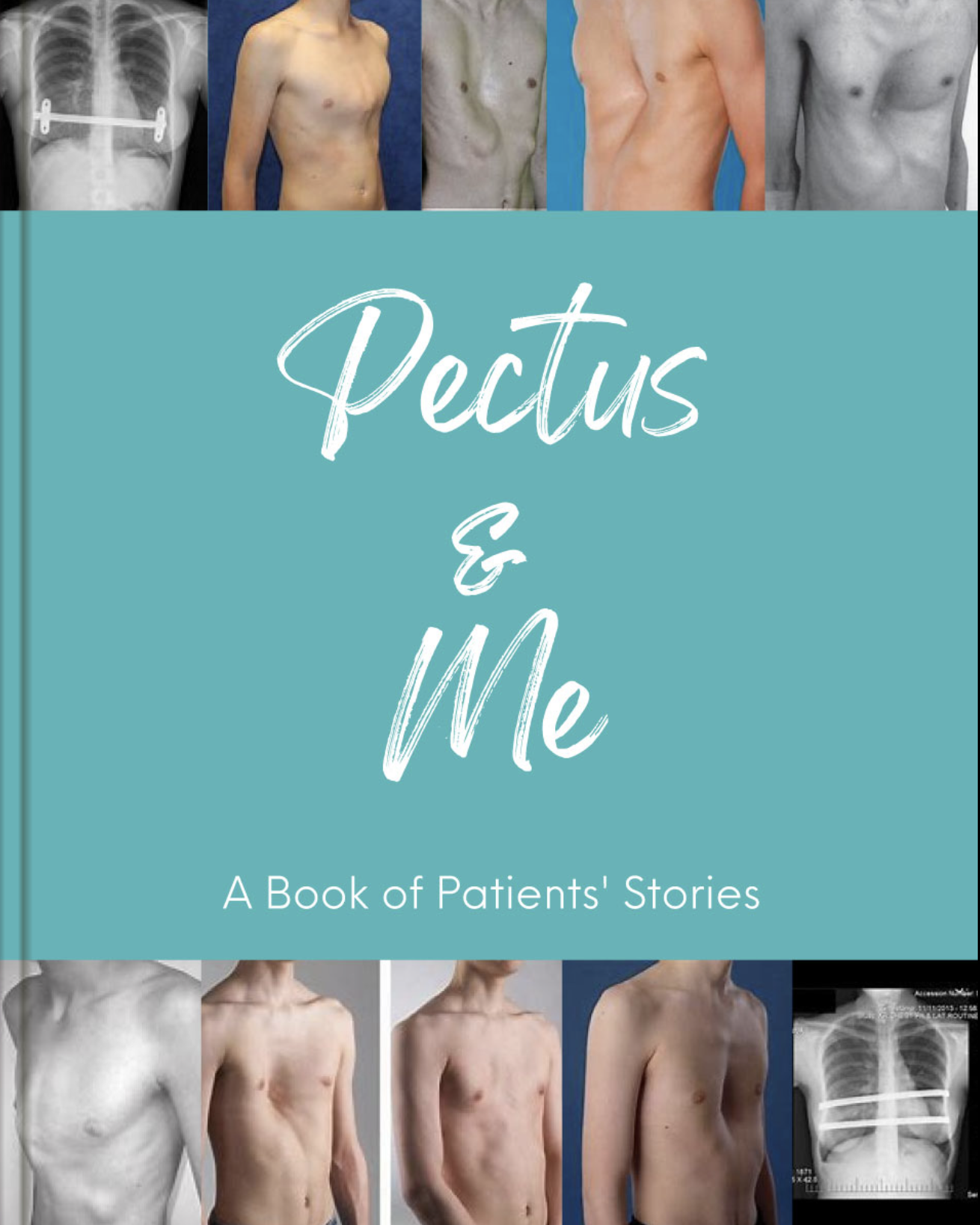 Book cover titled 'Pectus & Me: A Book of Patients' Stories' with images of male patients with chest deformities and X-ray images of their chests.
