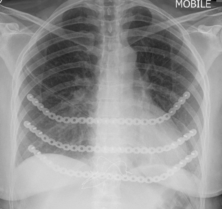 X-ray of a human chest showing two metal chains across the ribs.