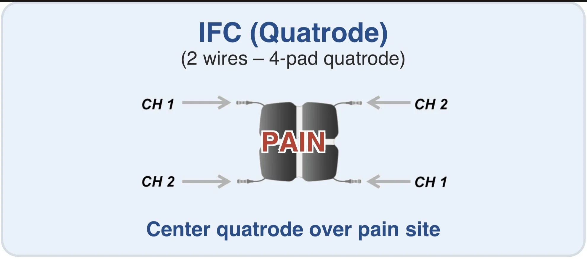 Diagram showing an IV (intravenous) quadrode with four wires, labeled as 2 wires - 4-pad quatrode, with the center quadrode positioned over a pain site for pain management.