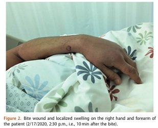 A person lying in bed with their arm resting on a floral-patterned blanket, the hand and forearm visible.