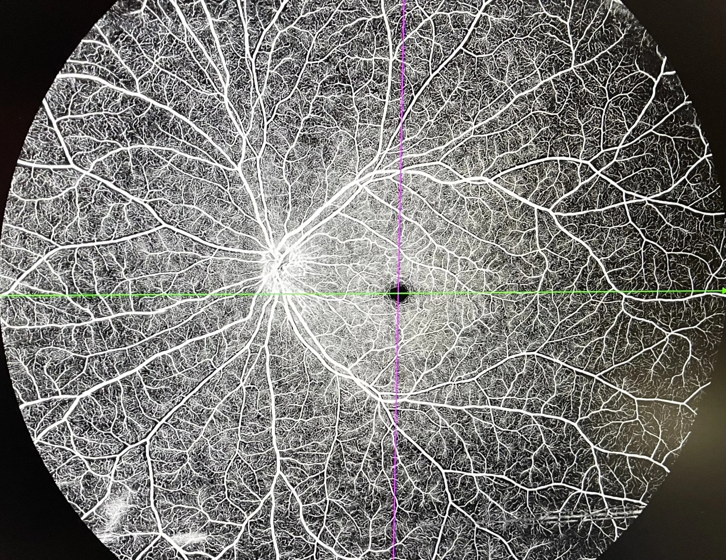 Close-up view of a detailed leaf skeleton with a dark background, showing intricate branching patterns, with a pink vertical and a green horizontal line overlayed.