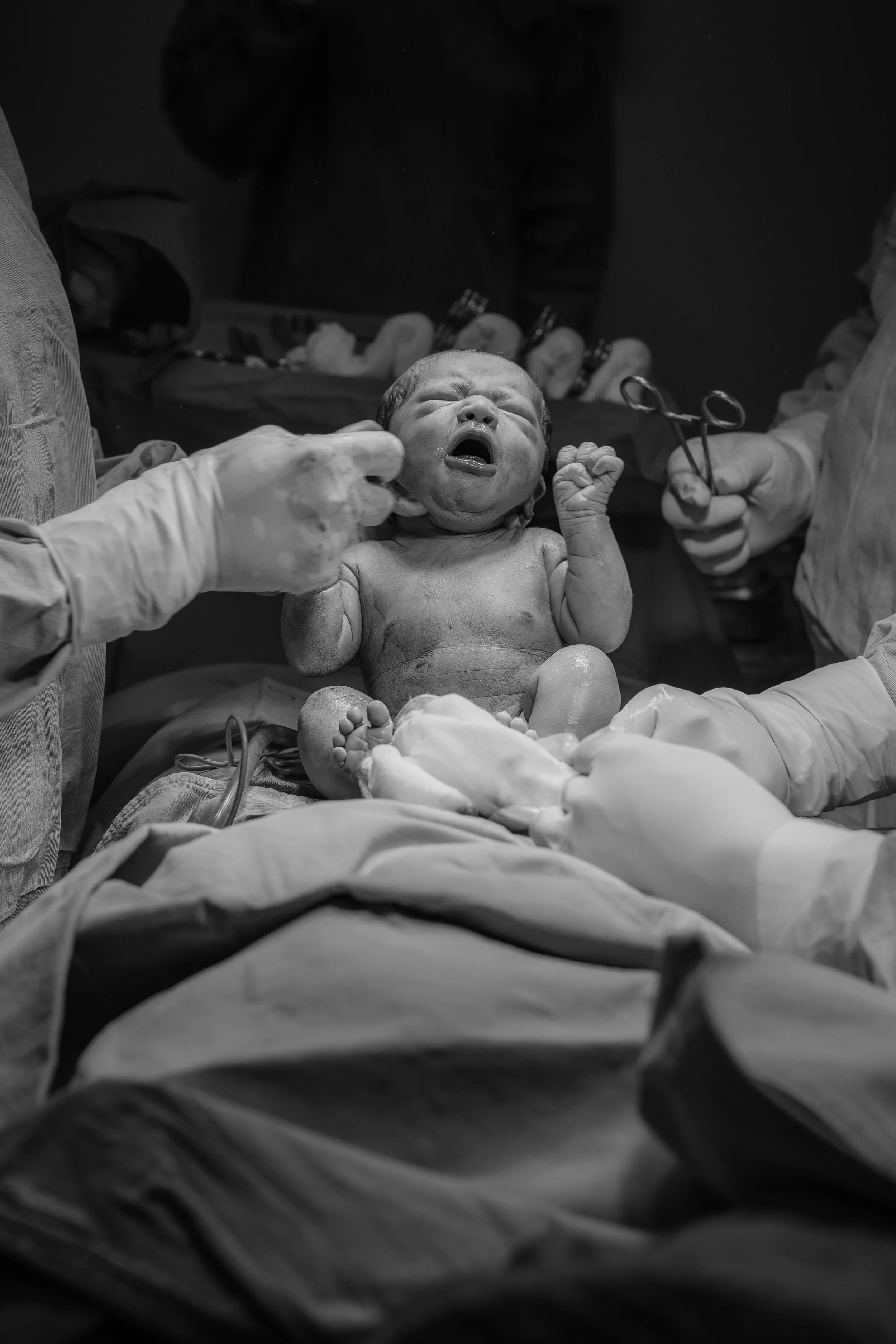 A newborn baby on an operating table immediately after birth, with healthcare professionals assisting during a cesarean section in a hospital operating room.