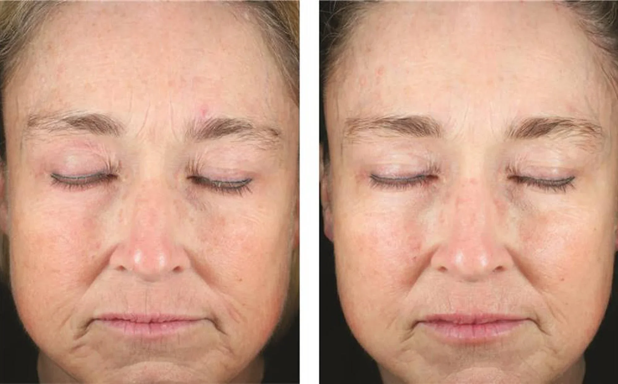 Skinbetter-Mystro Revive-7.webp