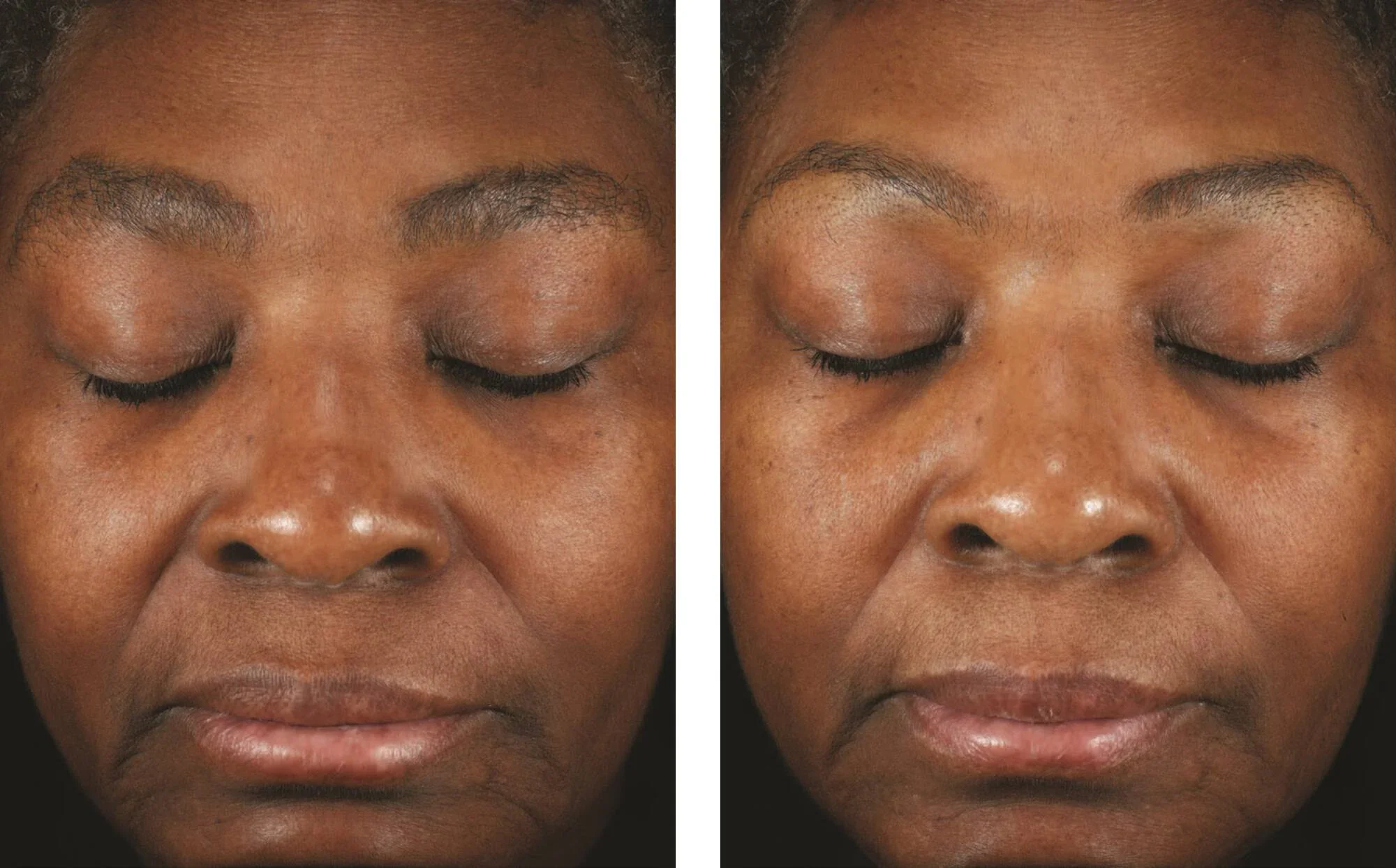 Skinbetter-Mystro Revive-6.webp