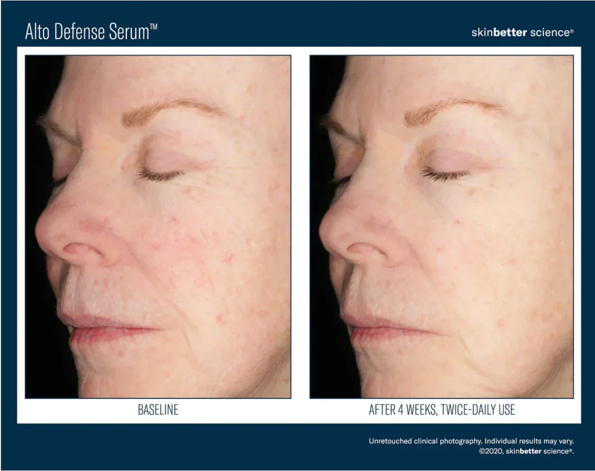 Skinbetter-Alto Advance-3.webp