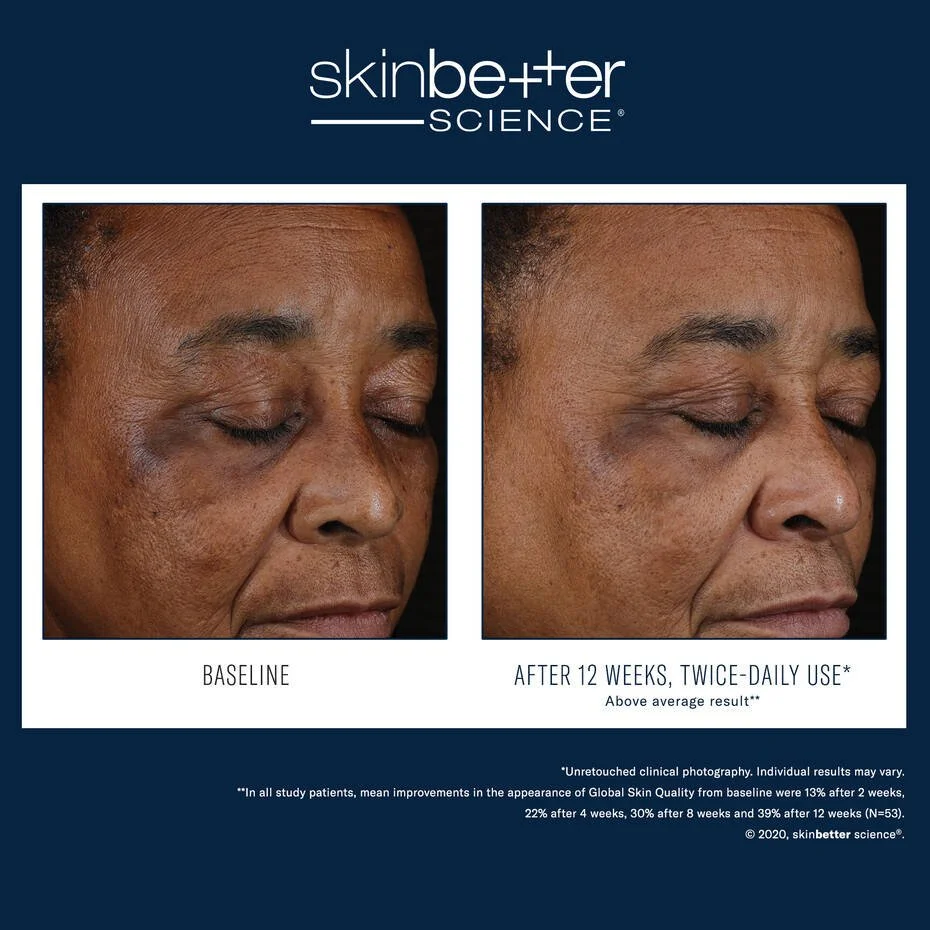 Skinbetter-Mystro-Rosacea-2.jpg