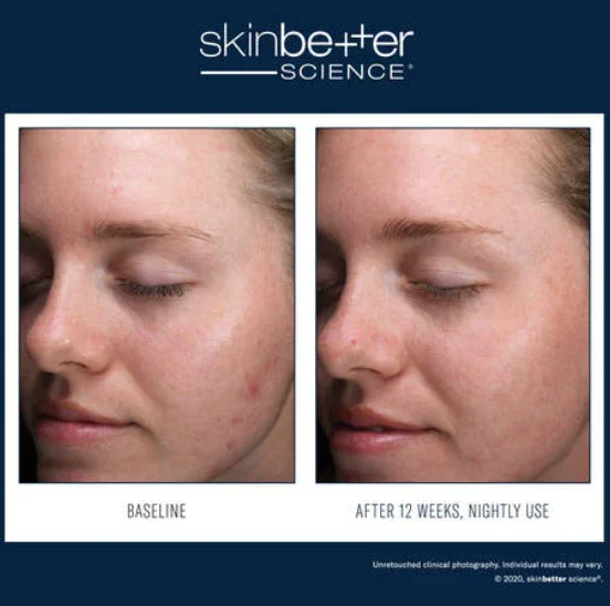 Skinbetter-Alpharet-serum-2.webp