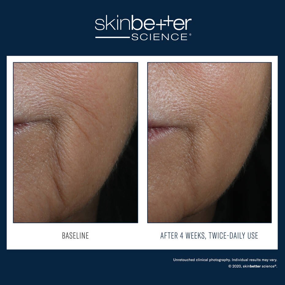 Skinbetter-InterFuse-2.jpg