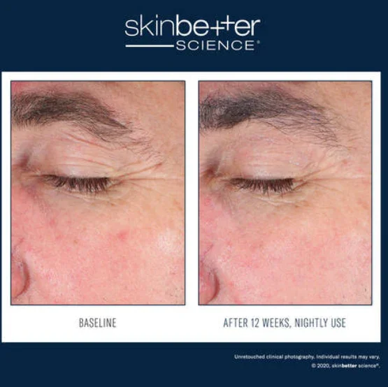Skinbetter-EyeMax-2.webp