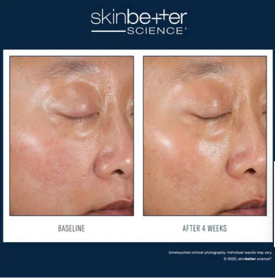 Skinbetter-Duo kit-2.webp