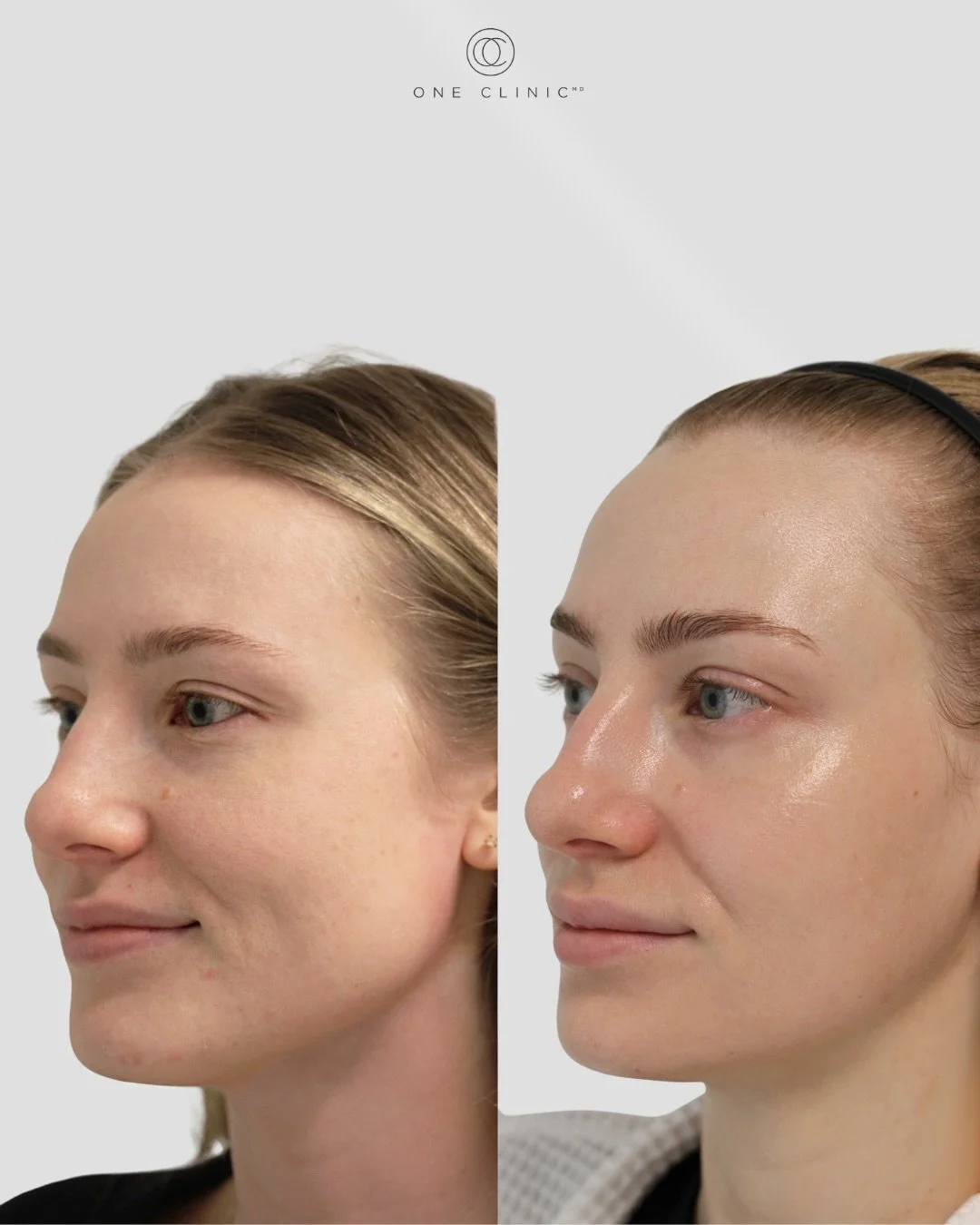 We don&rsquo;t start with a treatment. We start with your skin.

Lindsey&rsquo;s skin was dehydrated, a little dull, and missing that healthy, radiant glow. Rather than focusing on just one concern, we looked at what her skin needed as a whole and cr