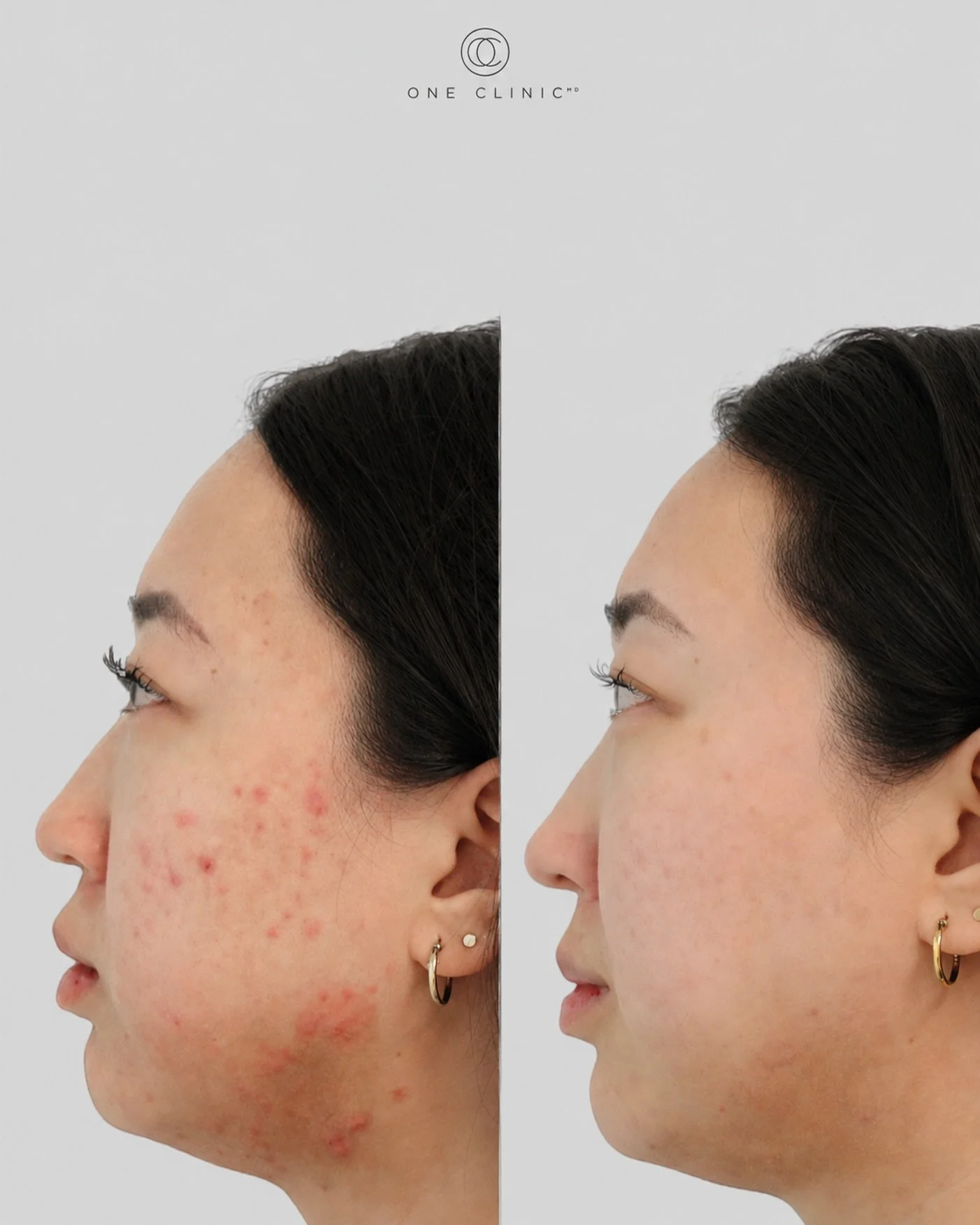 Six sessions of Aerolase. 

If you&rsquo;ve been dealing with breakouts, this is what consistency can look like.

Our Summer Series runs through September 1st &mdash; before regular pricing returns☀️

💻 Book: OneClinicMD.com⁣⁣⁣⁣⁣⁣⠀⁣
🛒 Shop: ShopOne