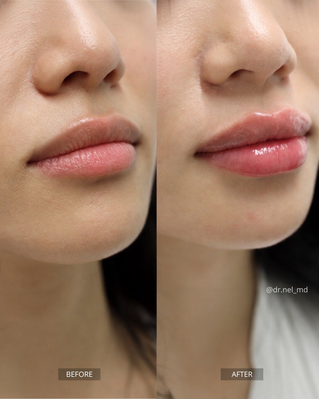 Subtle. Balanced. Still you.

@dr.nel_md 's approach to lip augmentation enhances shape, definition, and volume without looking overdone &mdash; just soft, natural results.

💻 Book: OneClinicMD.com⁣⁣⁣⁣⁣⁣⠀⁣
🛒 Shop: ShopOneClinicMD.com⁣⁣⁣⁣⁣⁣⠀⁣
✉️ Ema