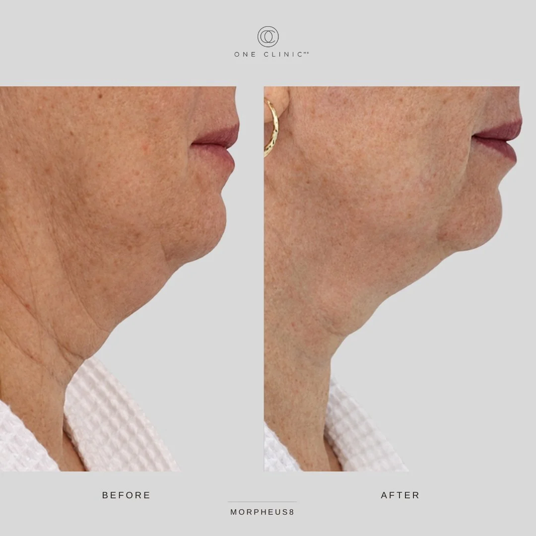 How Morpheus8 tightens skin⚡

Microneedles deliver radiofrequency energy beneath the surface. The heat contracts the collagen that's already there &mdash; that's what starts to change the contour along your jawline and neck. Over the following weeks,