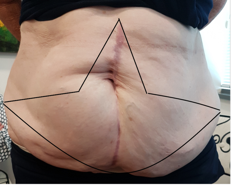 Clinical planning image showing the skin marked for removal during Fleur-de-Lis abdominoplasty
