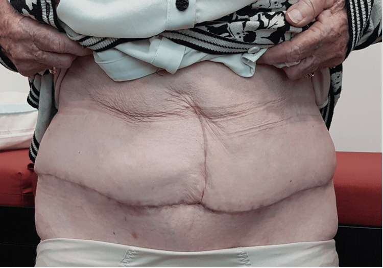 Clinical photograph six months after Fleur-de-Lis abdominoplasty with the belly button removed