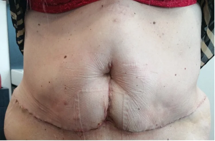 Image showing an anchor-shaped abdominal incision used in selected abdominal wall reconstructions
