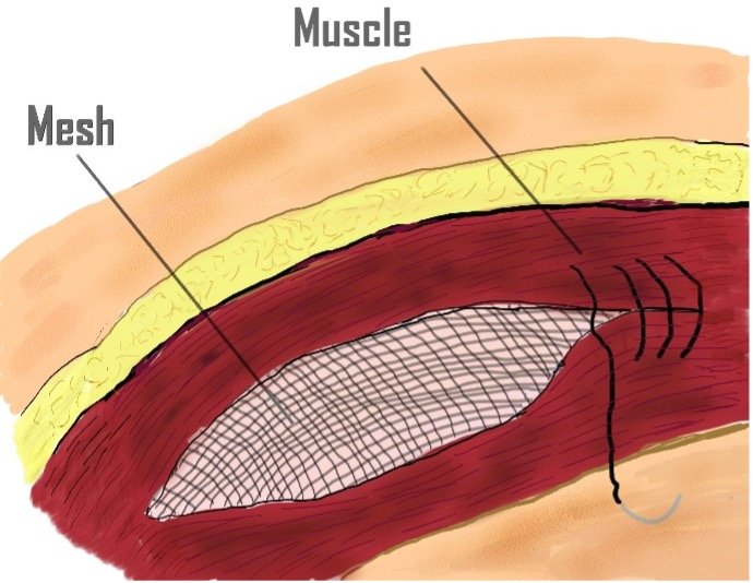 Illustration showing mesh positioned beneath the abdominal muscle layers