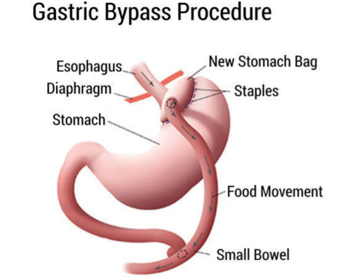 Diagram of gastric bypass showing the small stomach pouch connected to the small bowel and the route food takes after surgery