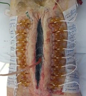 Clinical photograph showing an ABRA dynamic abdominal closure system