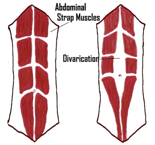 Illustration comparing normal abdominal muscles with divarication or rectus diastasis